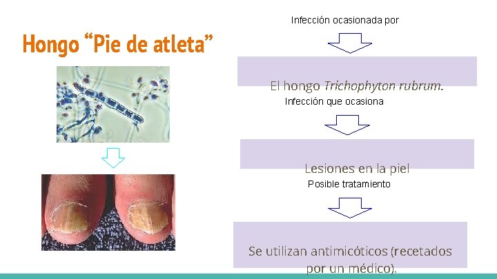 Infección ocasionada por Hongo “Pie de atleta” El hongo Trichophyton rubrum. Infección que ocasiona Infección ocasionada por Hongo “Pie de atleta” El hongo Trichophyton rubrum. Infección que ocasiona