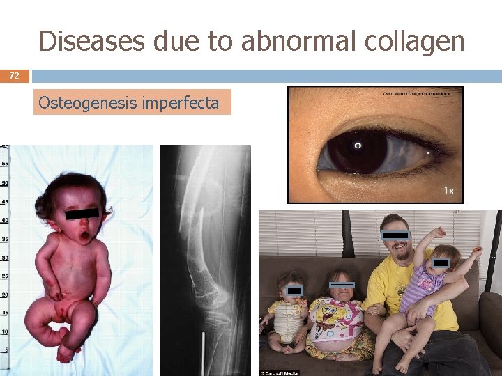 Diseases due to abnormal collagen 72 Osteogenesis imperfecta 
