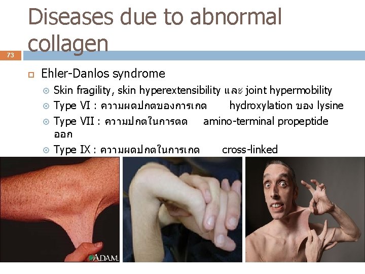 73 Diseases due to abnormal collagen Ehler-Danlos syndrome Skin fragility, skin hyperextensibility และ joint
