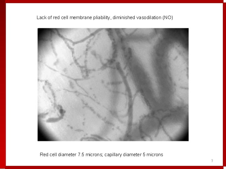 Lack of red cell membrane pliability, diminished vasodilation (NO) Red cell diameter 7. 5 Lack of red cell membrane pliability, diminished vasodilation (NO) Red cell diameter 7. 5