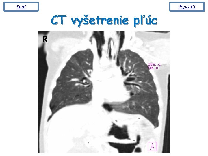 Späť Popis CT CT vyšetrenie pľúc R 