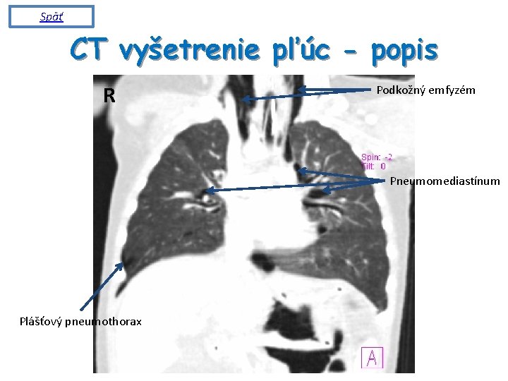 Späť CT vyšetrenie pľúc - popis R Podkožný emfyzém Pneumomediastínum Plášťový pneumothorax 