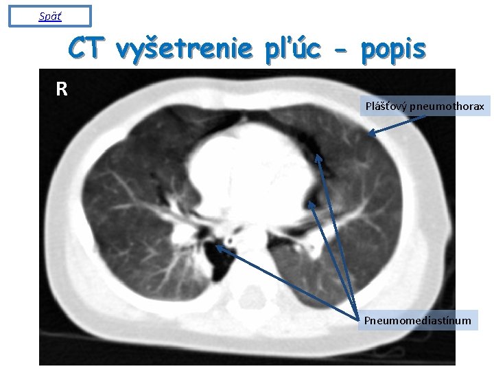 Späť CT vyšetrenie pľúc - popis R Plášťový pneumothorax Pneumomediastínum 