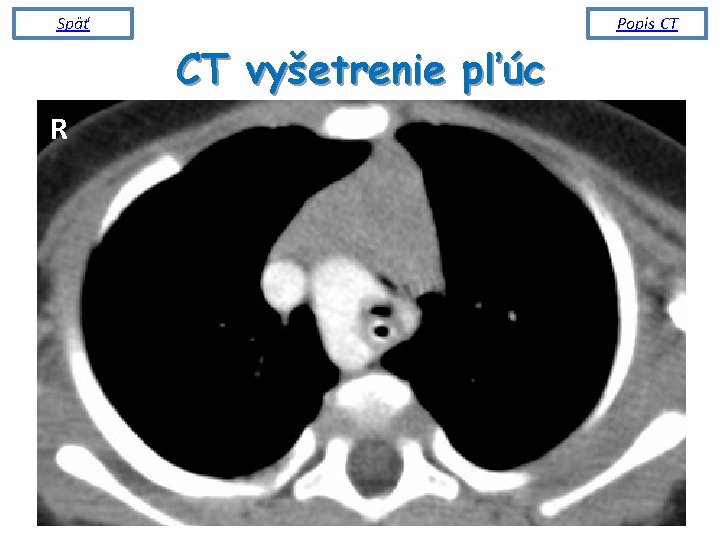 Späť Popis CT CT vyšetrenie pľúc R 