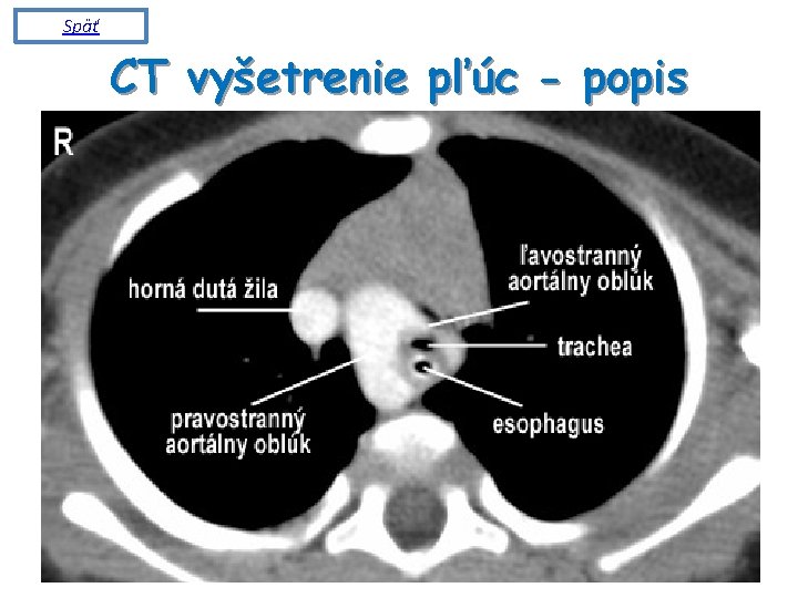 Späť CT vyšetrenie pľúc - popis 