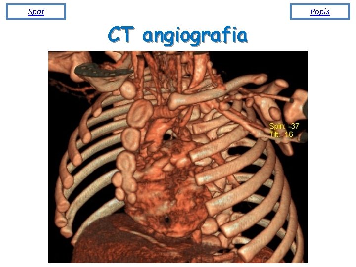 Späť Popis CT angiografia R 
