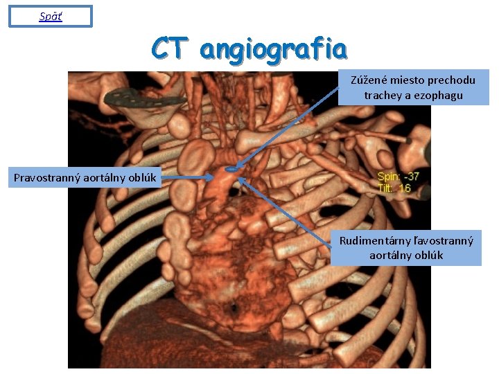 Späť CT angiografia R Zúžené miesto prechodu trachey a ezophagu Pravostranný aortálny oblúk Rudimentárny