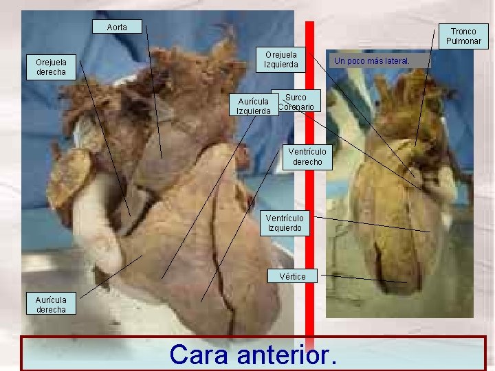 Aorta Orejuela derecha Tronco Pulmonar Orejuela Izquierda Un poco más lateral. Surco Aurícula Izquierda Aorta Orejuela derecha Tronco Pulmonar Orejuela Izquierda Un poco más lateral. Surco Aurícula Izquierda