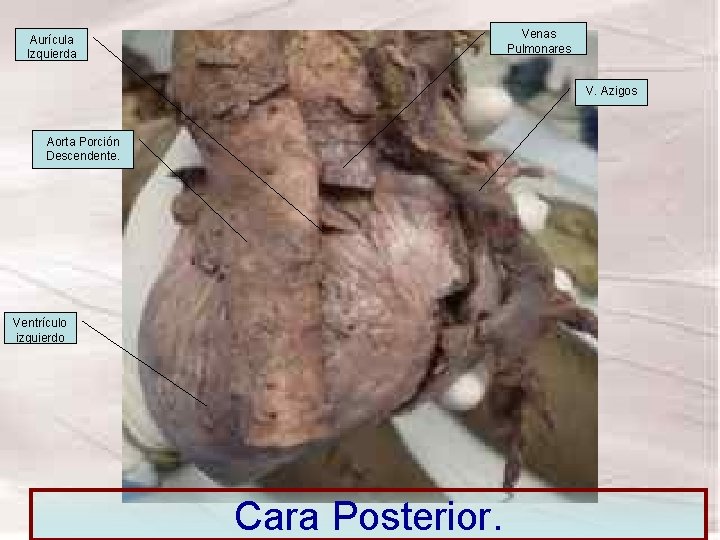 Venas Pulmonares Aurícula Izquierda V. Azigos Aorta Porción Descendente. Ventrículo izquierdo Cara Posterior. Venas Pulmonares Aurícula Izquierda V. Azigos Aorta Porción Descendente. Ventrículo izquierdo Cara Posterior.
