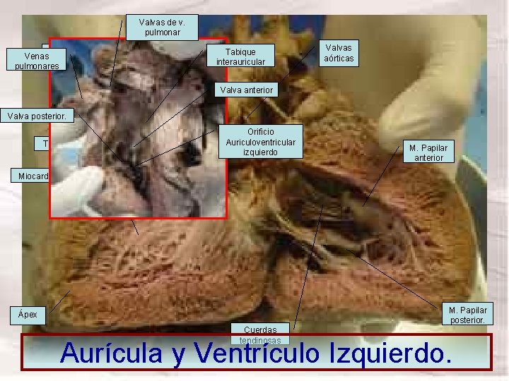 Venas Tabique interventricular pulmonares Valvas de v. pulmonar Vestíbulo aórtico Tabique interauricular Valvas aórticas Venas Tabique interventricular pulmonares Valvas de v. pulmonar Vestíbulo aórtico Tabique interauricular Valvas aórticas