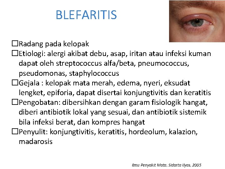 BLEFARITIS �Radang pada kelopak �Etiologi: alergi akibat debu, asap, iritan atau infeksi kuman dapat BLEFARITIS �Radang pada kelopak �Etiologi: alergi akibat debu, asap, iritan atau infeksi kuman dapat