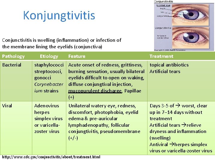 Konjungtivitis Conjunctivitis is swelling (inflammation) or infection of the membrane lining the eyelids (conjunctiva) Konjungtivitis Conjunctivitis is swelling (inflammation) or infection of the membrane lining the eyelids (conjunctiva)