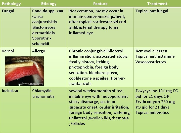 Pathology Etiology Feature Treatment Fungal Candida spp. can cause conjunctivitis Blastomyces dermatitidis Sporothrix schenckii Pathology Etiology Feature Treatment Fungal Candida spp. can cause conjunctivitis Blastomyces dermatitidis Sporothrix schenckii