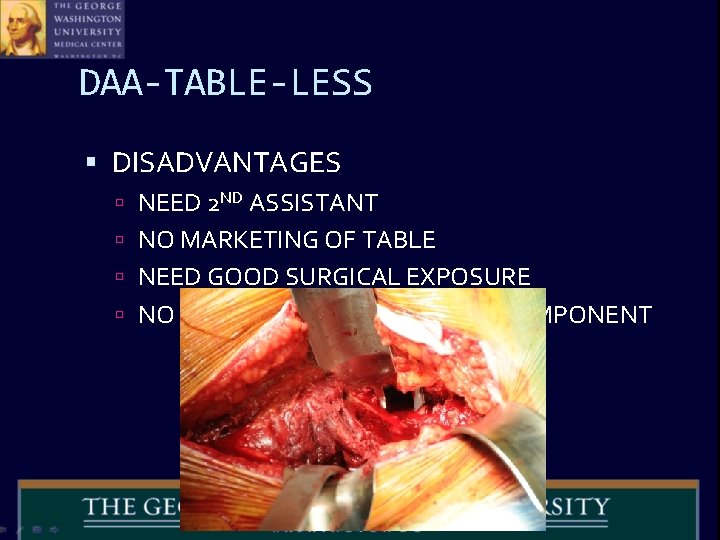 DAA-TABLE-LESS DISADVANTAGES NEED 2 ND ASSISTANT NO MARKETING OF TABLE NEED GOOD SURGICAL EXPOSURE