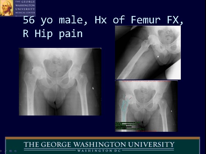 56 yo male, Hx of Femur FX, R Hip pain 