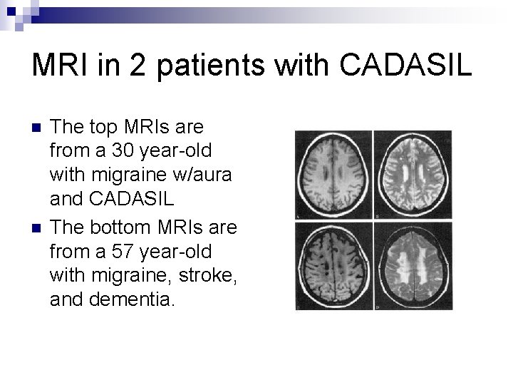 MRI in 2 patients with CADASIL n n The top MRIs are from a