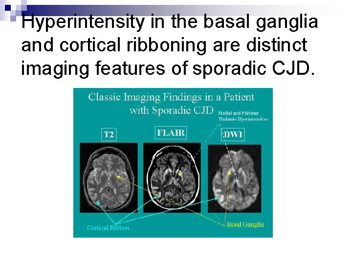 Hyperintensity in the basal ganglia and cortical ribboning are distinct imaging features of sporadic
