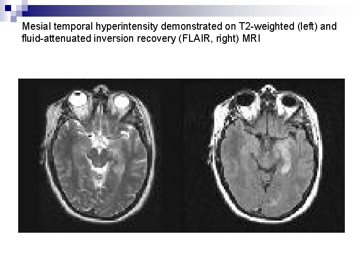 Mesial temporal hyperintensity demonstrated on T 2 -weighted (left) and fluid-attenuated inversion recovery (FLAIR,