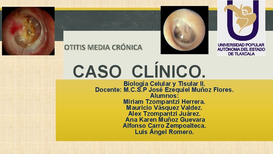 OTITIS MEDIA CRÓNICA CASO CLÍNICO. Biología Celular y Tisular II. Docente: M. C. S.