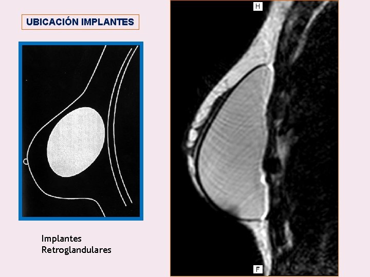 UBICACIÓN IMPLANTES Implantes Retroglandulares 