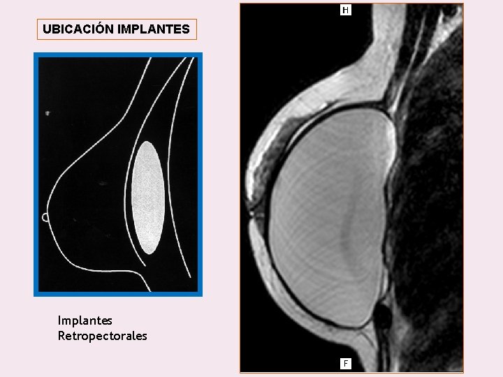 UBICACIÓN IMPLANTES Implantes Retropectorales 