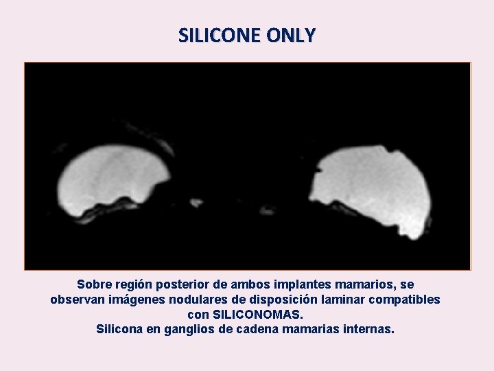 SILICONE ONLY Sobre región posterior de ambos implantes mamarios, se observan imágenes nodulares de