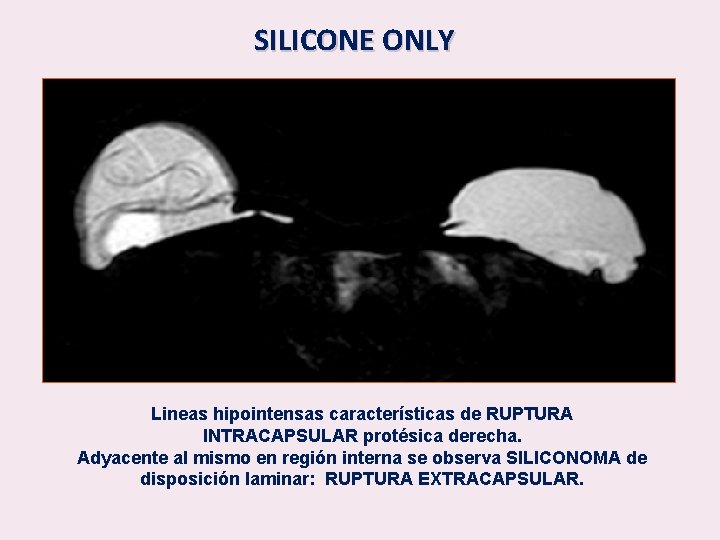 SILICONE ONLY Lineas hipointensas características de RUPTURA INTRACAPSULAR protésica derecha. Adyacente al mismo en