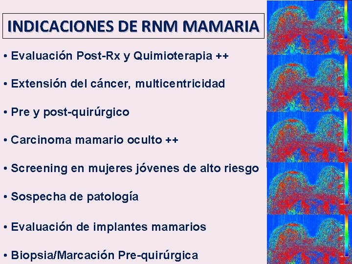 INDICACIONES DE RNM MAMARIA • Evaluación Post-Rx y Quimioterapia ++ • Extensión del cáncer,