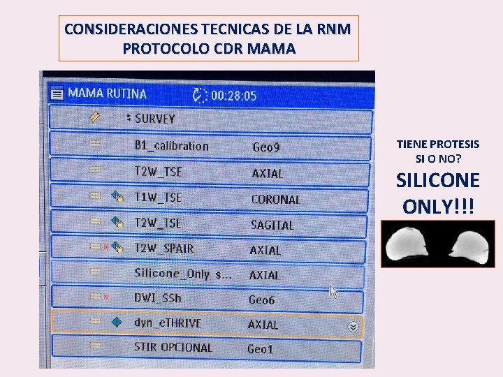 CONSIDERACIONES TECNICAS DE LA RNM PROTOCOLO CDR MAMA TIENE PROTESIS SI O NO? SILICONE