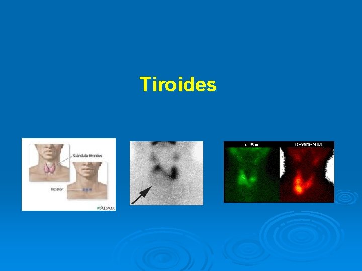 Tiroides 