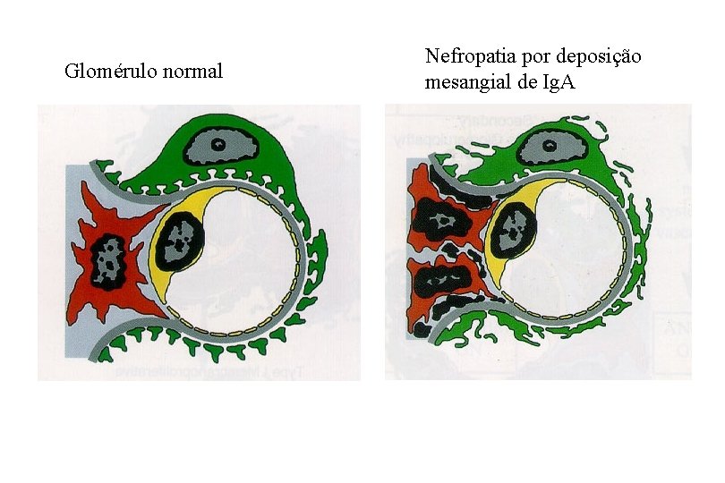 Glomérulo normal Nefropatia por deposição mesangial de Ig. A 