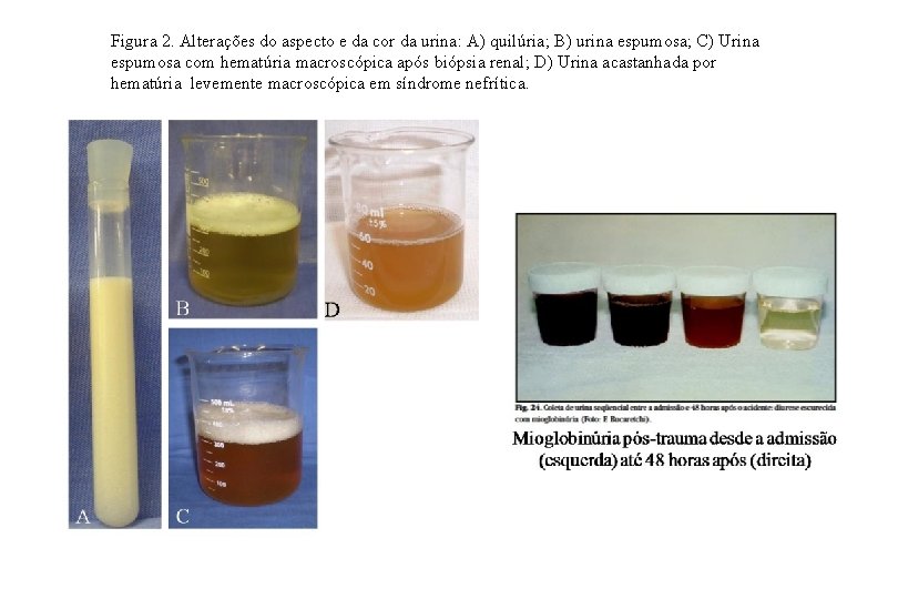 Figura 2. Alterações do aspecto e da cor da urina: A) quilúria; B) urina