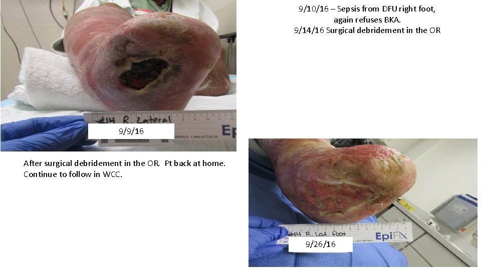 9/10/16 – Sepsis from DFU right foot, again refuses BKA. 9/14/16 Surgical debridement in