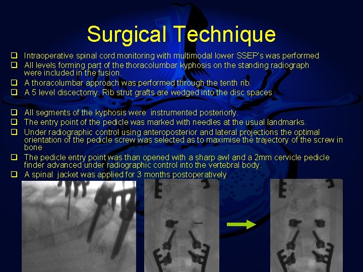 Surgical Technique q Intraoperative spinal cord monitoring with multimodal lower SSEP’s was performed q