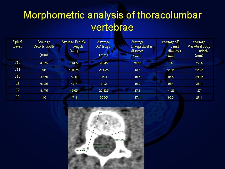 Morphometric analysis of thoracolumbar vertebrae Spinal Level Average Pedicle width (mm) Average Pedicle length