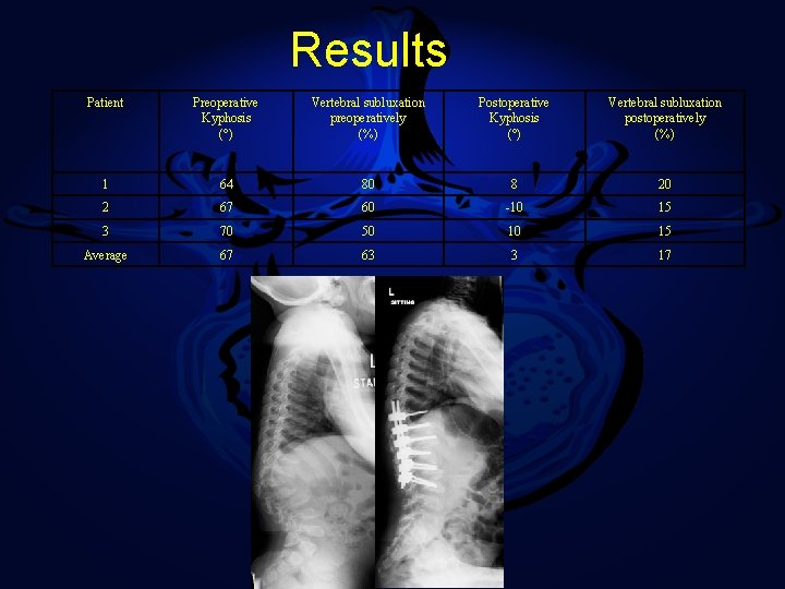 Results Patient Preoperative Kyphosis (°) Vertebral subluxation preoperatively (%) Postoperative Kyphosis (°) Vertebral subluxation