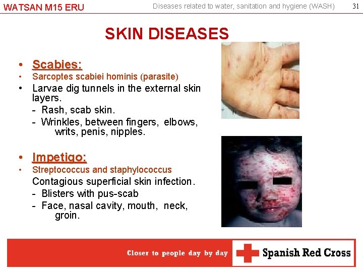 WATSAN M 15 ERU Diseases related to water, sanitation and hygiene (WASH) SKIN DISEASES