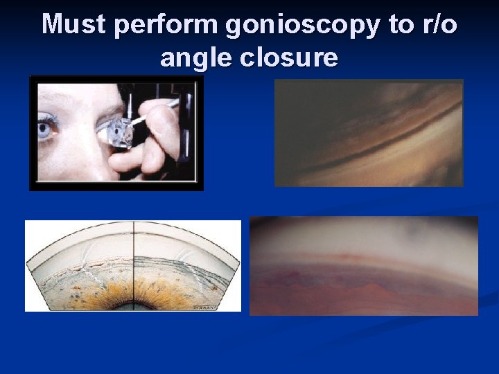 Must perform gonioscopy to r/o angle closure 