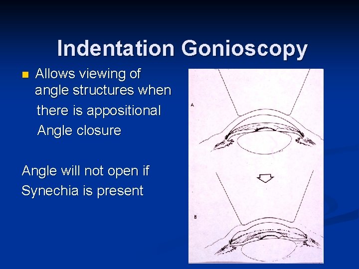 Indentation Gonioscopy n Allows viewing of angle structures when there is appositional Angle closure