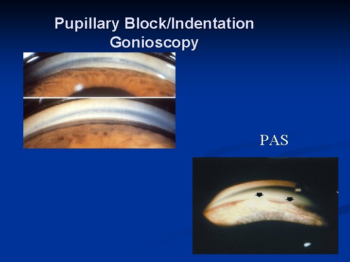 Pupillary Block/Indentation Gonioscopy PAS 