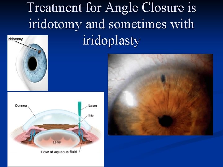 Treatment for Angle Closure is iridotomy and sometimes with iridoplasty 