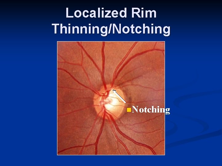 Localized Rim Thinning/Notching n. Notching 