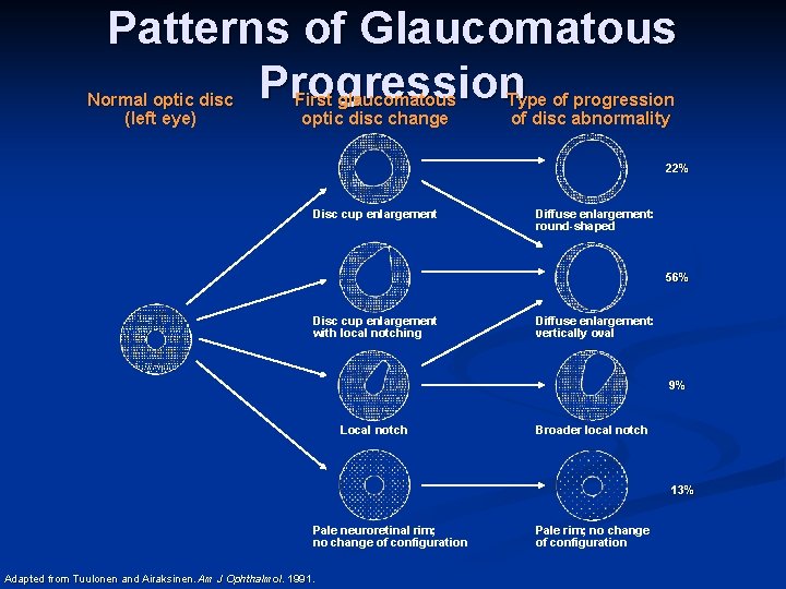 Patterns of Glaucomatous Progression Normal optic disc (left eye) First glaucomatous optic disc change