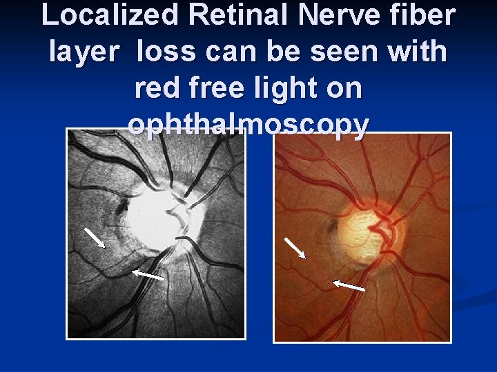 Localized Retinal Nerve fiber layer loss can be seen with red free light on