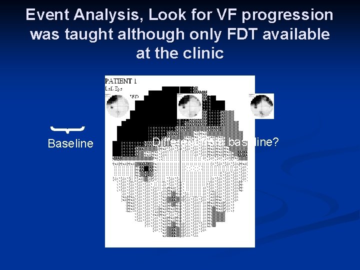 Event Analysis, Look for VF progression was taught although only FDT available at the