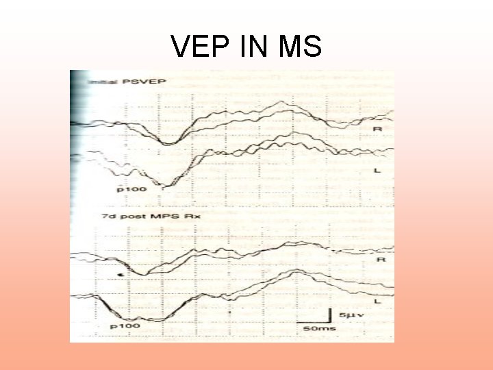 VEP IN MS 