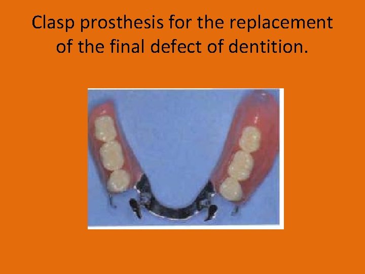 Clasp prosthesis for the replacement of the final defect of dentition. 