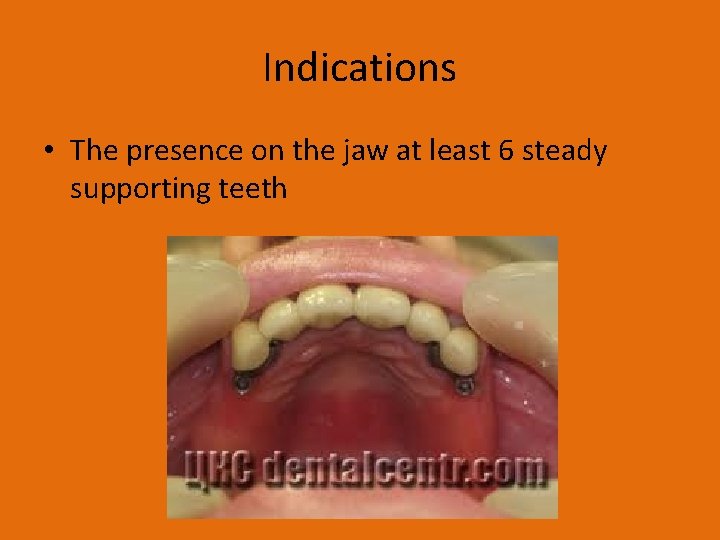 Indications • The presence on the jaw at least 6 steady supporting teeth 