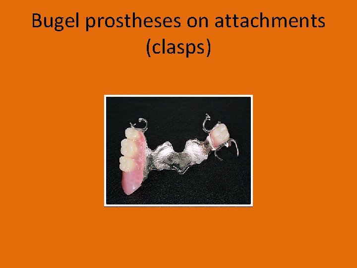 Bugel prostheses on attachments (clasps) 