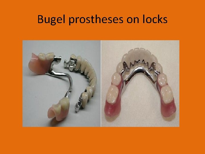 Bugel prostheses on locks 
